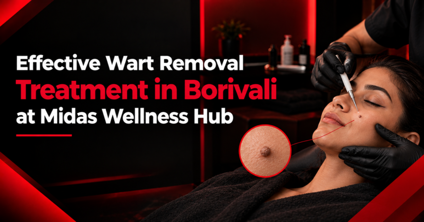 Wart Removal Treatment in Borivali Wart Removal Treatment in Borivali